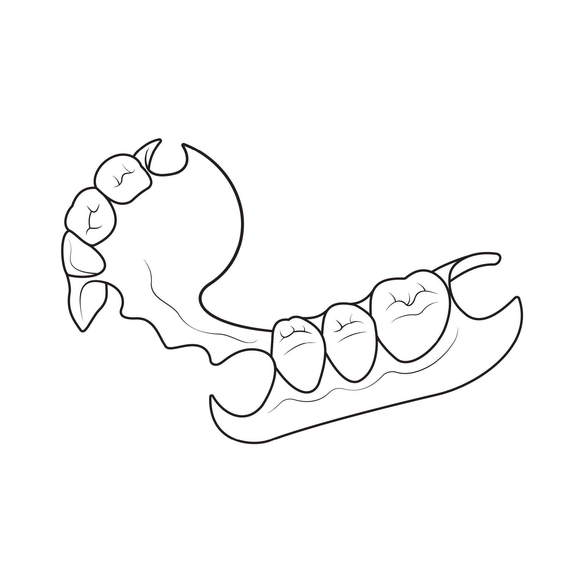 Apex Flex partial linear Apex Flex partial linear