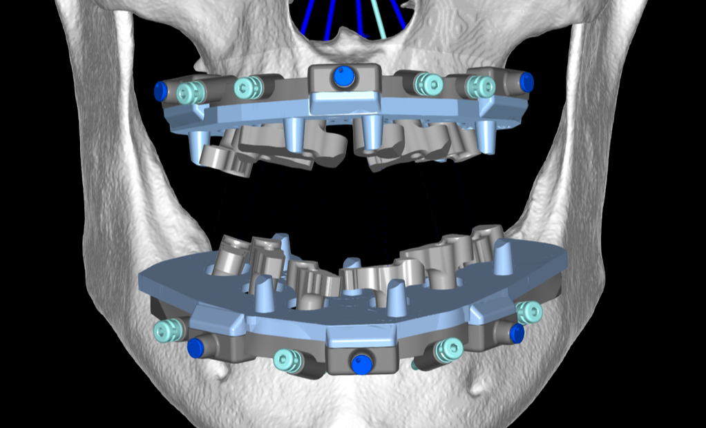 ArchBridge GuidedSMILE Digital Plan-2-1