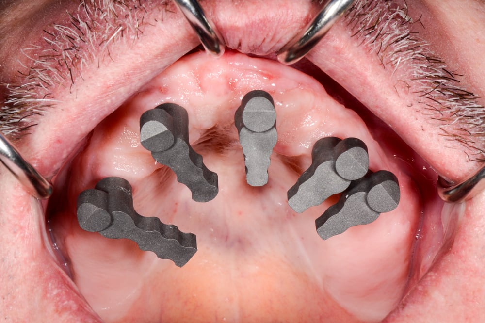 Archbridge Scanbodys Intraoral