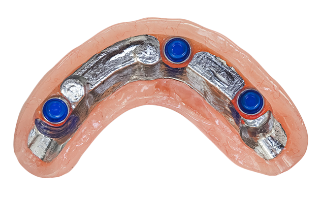 Bar Overdenture Overview@0.5x Bar Overdenture Overview@0.5x