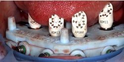 GuidedSMILE Digital ArchBridge Images (1)
