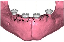 GuidedSMILE Digital ArchBridge Images (1)