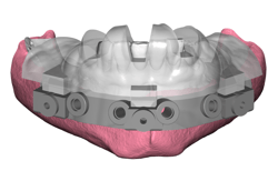 GuidedSMILE Digital ArchBridge Images (2)