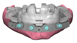 GuidedSMILE Digital ArchBridge Images (3)
