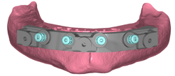 GuidedSMILE Digital ArchBridge Images (5)