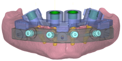 GuidedSMILE Digital ArchBridge Images (6)