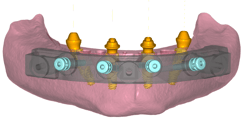 GuidedSMILE Digital ArchBridge Images (7)