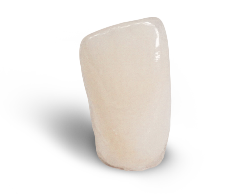 Cement-Retained Crown Overview Cement-Retained Crown Overview