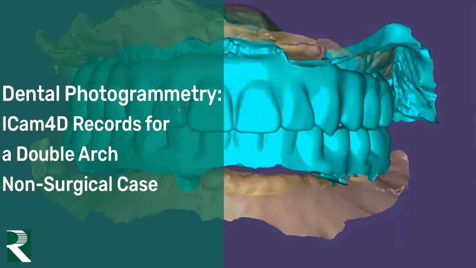 Dental-Photogrammetry-ICam4D-Records-for-a-Double-Arch-Non-Surgical-Case