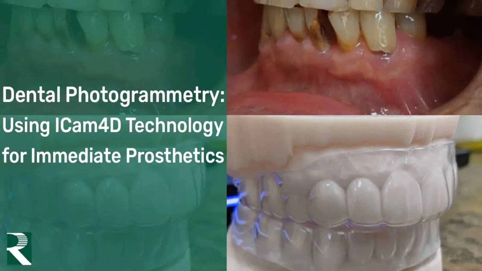 Dental-Photogrammetry-Using-ICam4D-Technology-for-Immediate-Prosthetics
