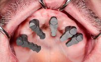 Existing Overdenture - 6