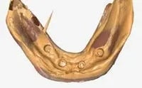 Existing overdenture - 2