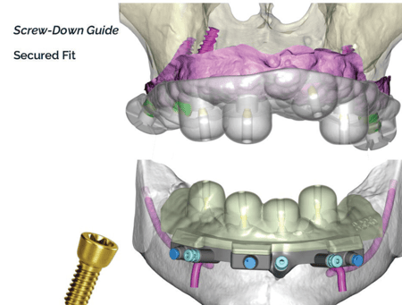 GSCaseStudy_screwdown