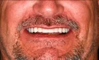 Healing Overdenture -2