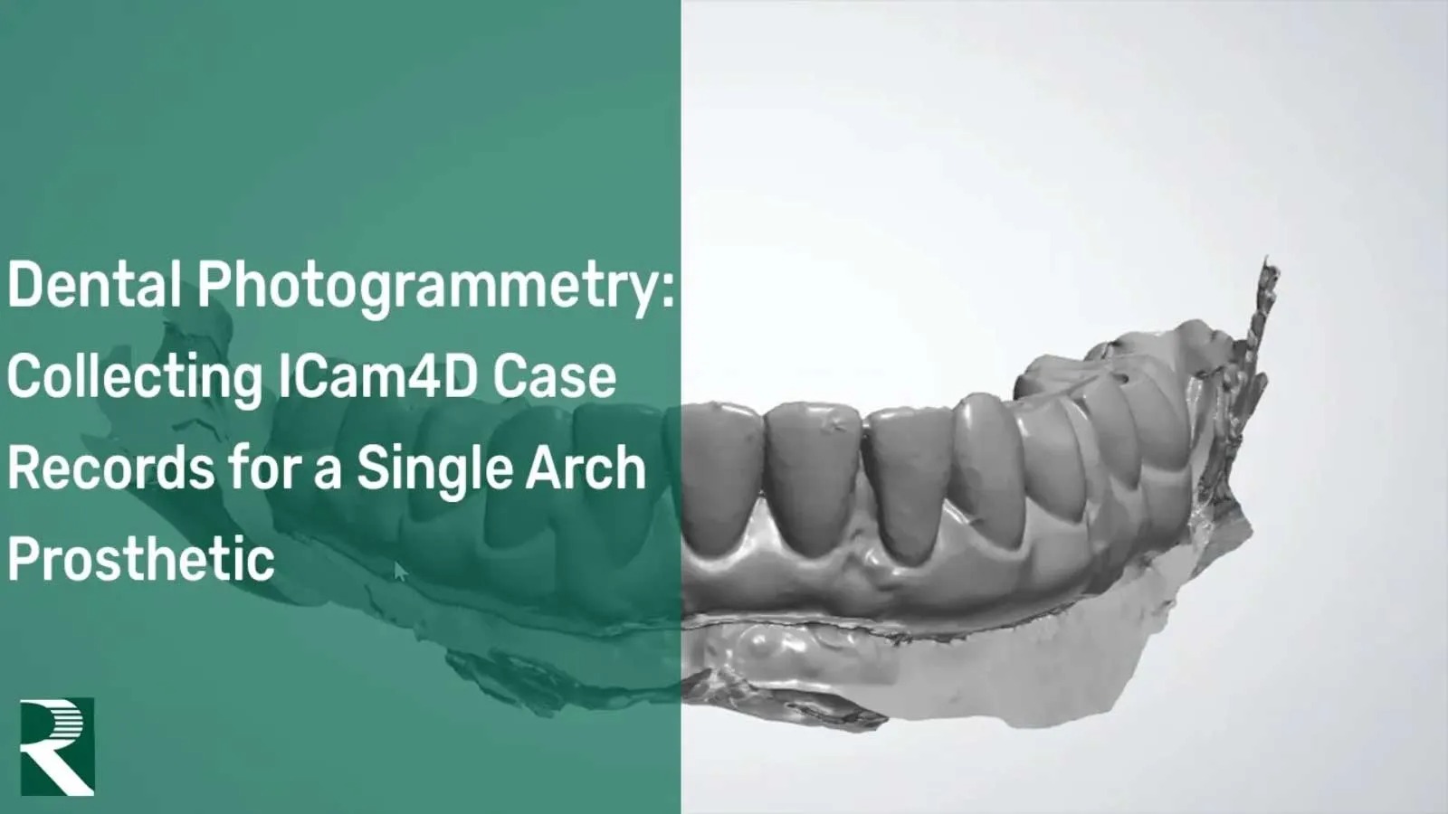 ICam4D-Collecting-Records-for-a-Single-Arch-Prosthetic