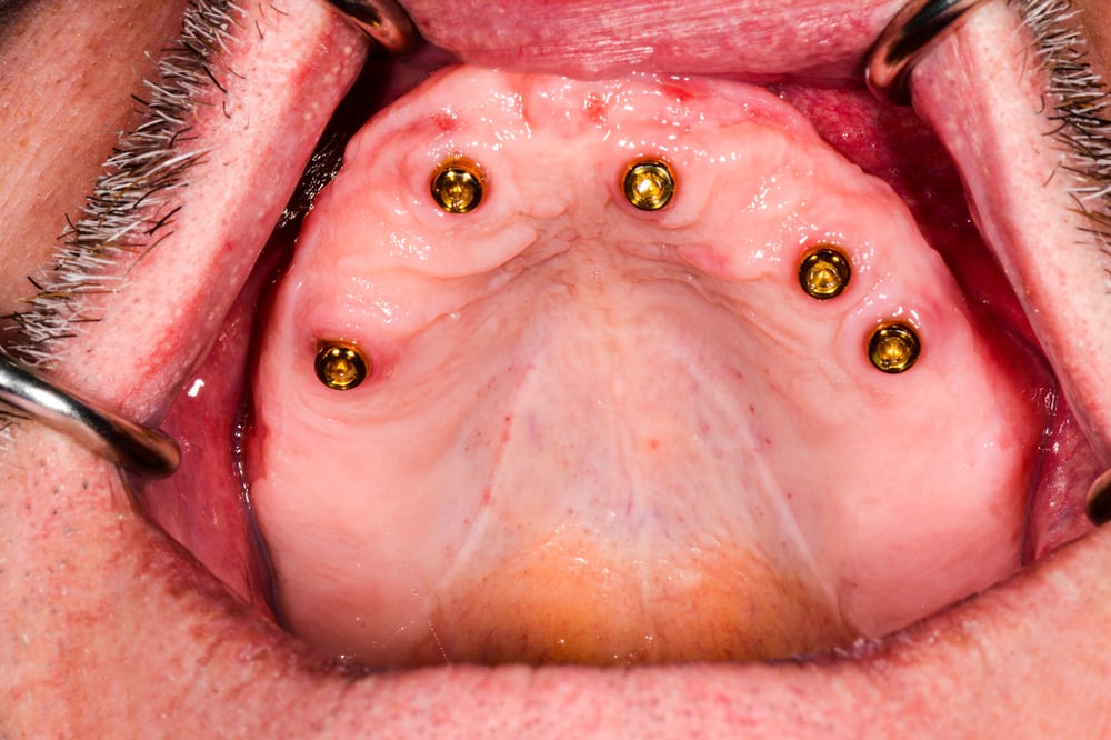 Locator Abutments-3