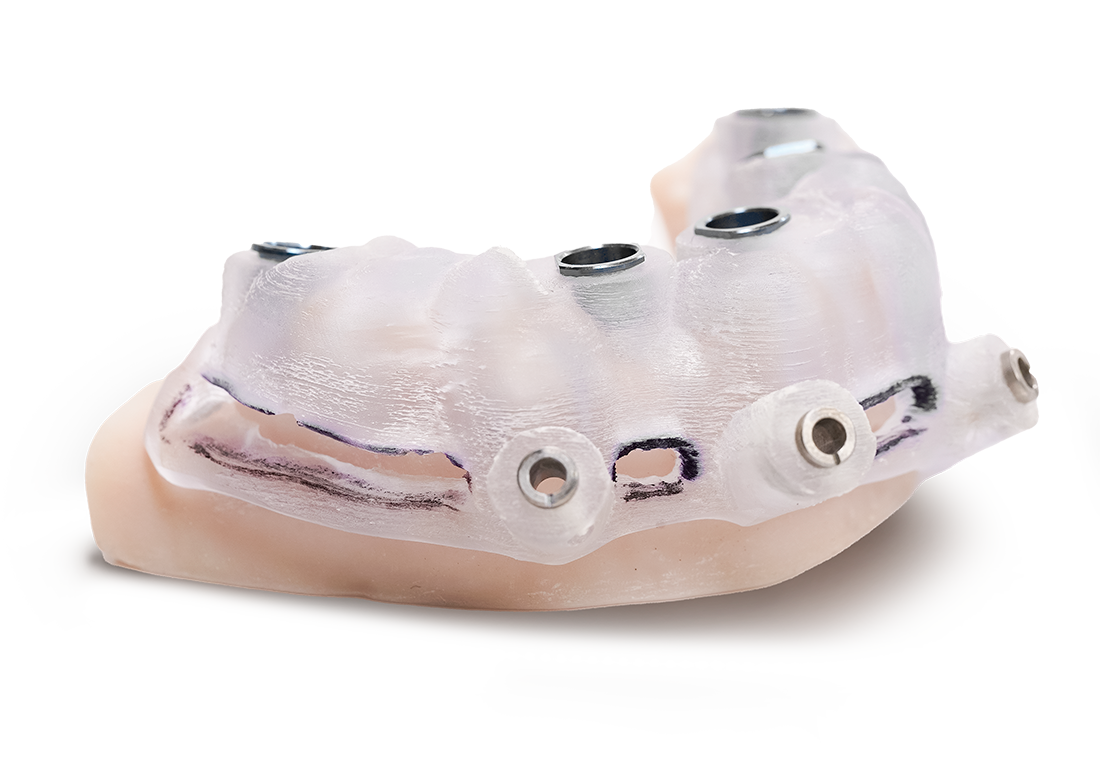 Bone-Supported Surgical Guide Overview@0.25x Bone-Supported Surgical Guide Overview@0.25x