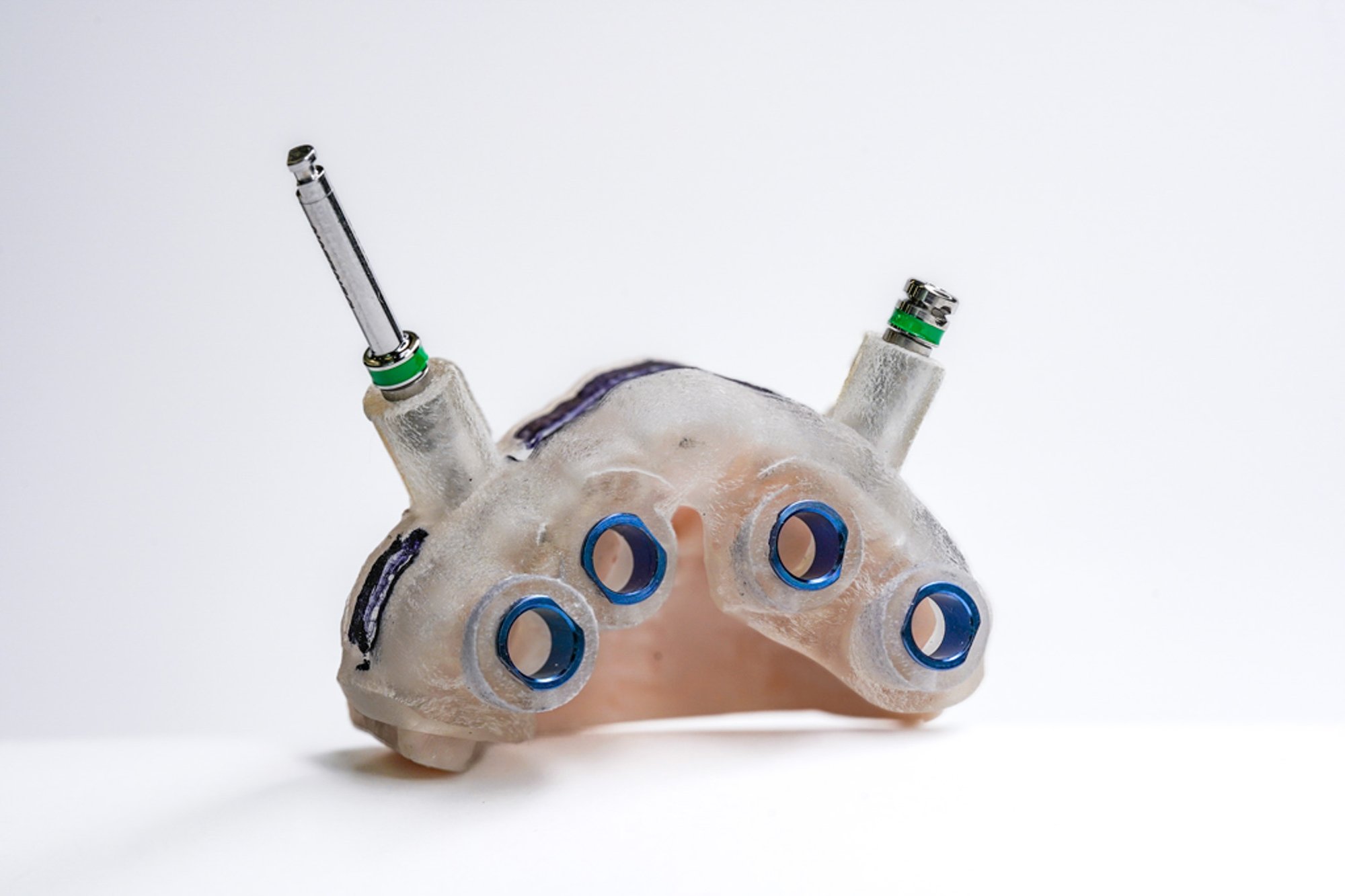 Edentulous-Bone-Channel-Surgical-Guide-01