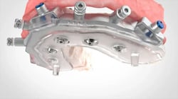 Abutments