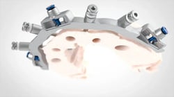 Bone-Reduction-After