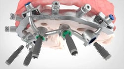Implants