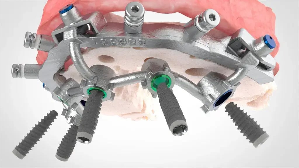 Implants