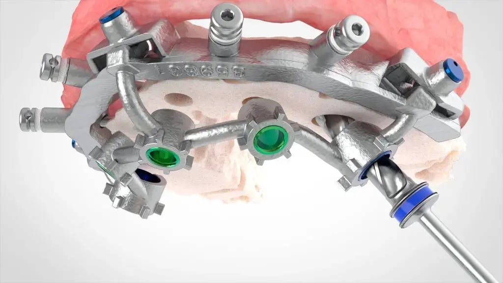 Osteotomy-Drilling
