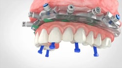 Provisional-Plugs-1
