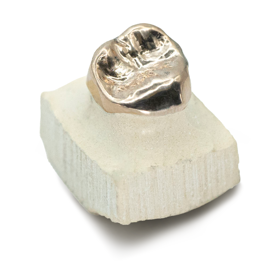 Metal Crown Overview Metal Crown Overview