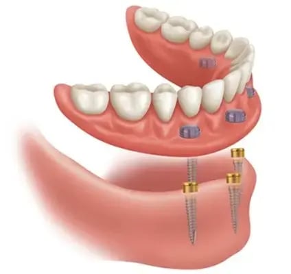 Full-Arch-Locator-Overdenture