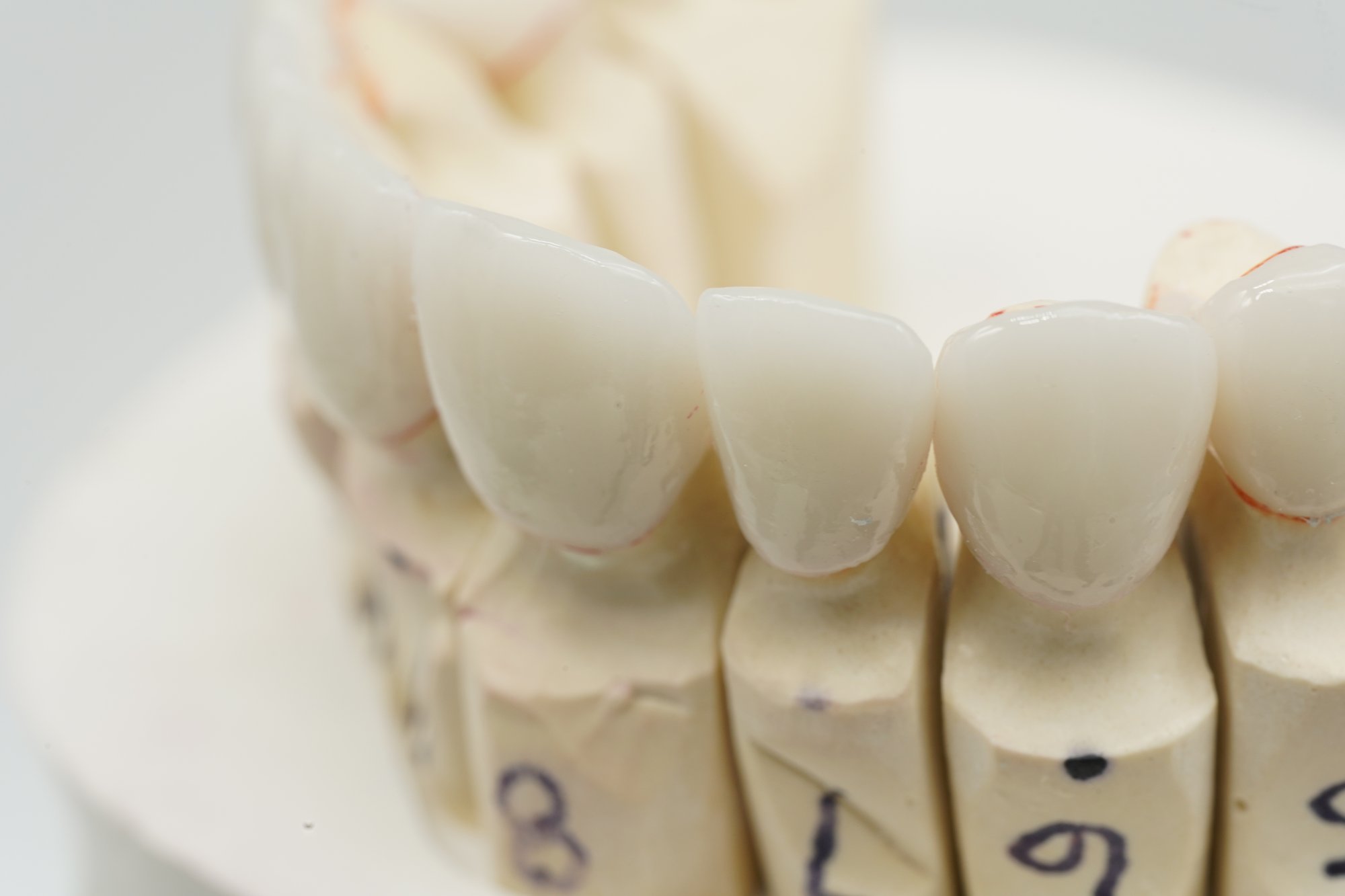 emax veneers