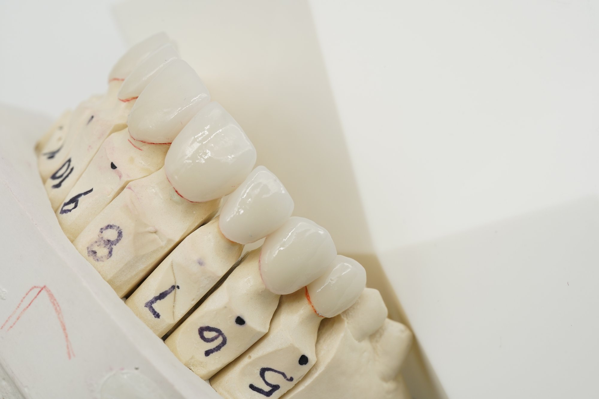 emax veneers