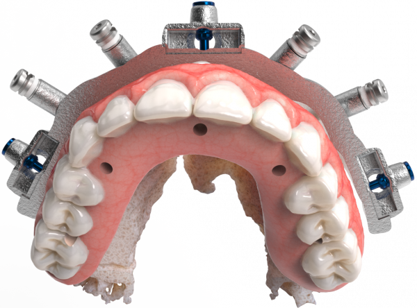CHROME-Components-Small-Hole-Prosthesis