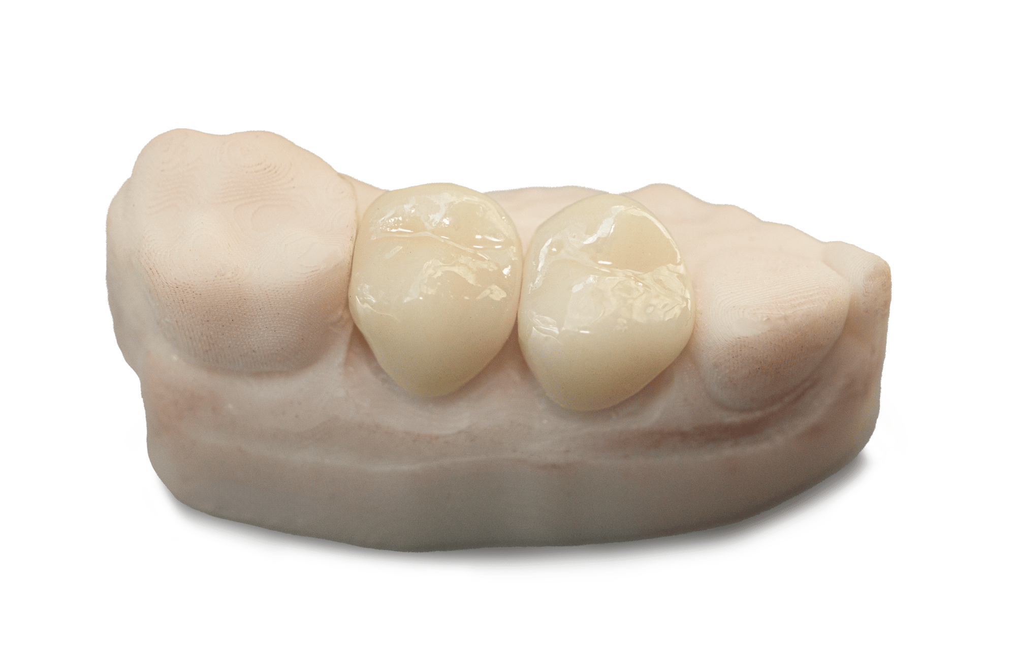 zRc Zirconia Crown Overview zRc Zirconia Crown Overview