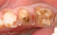 Prep the tooth
