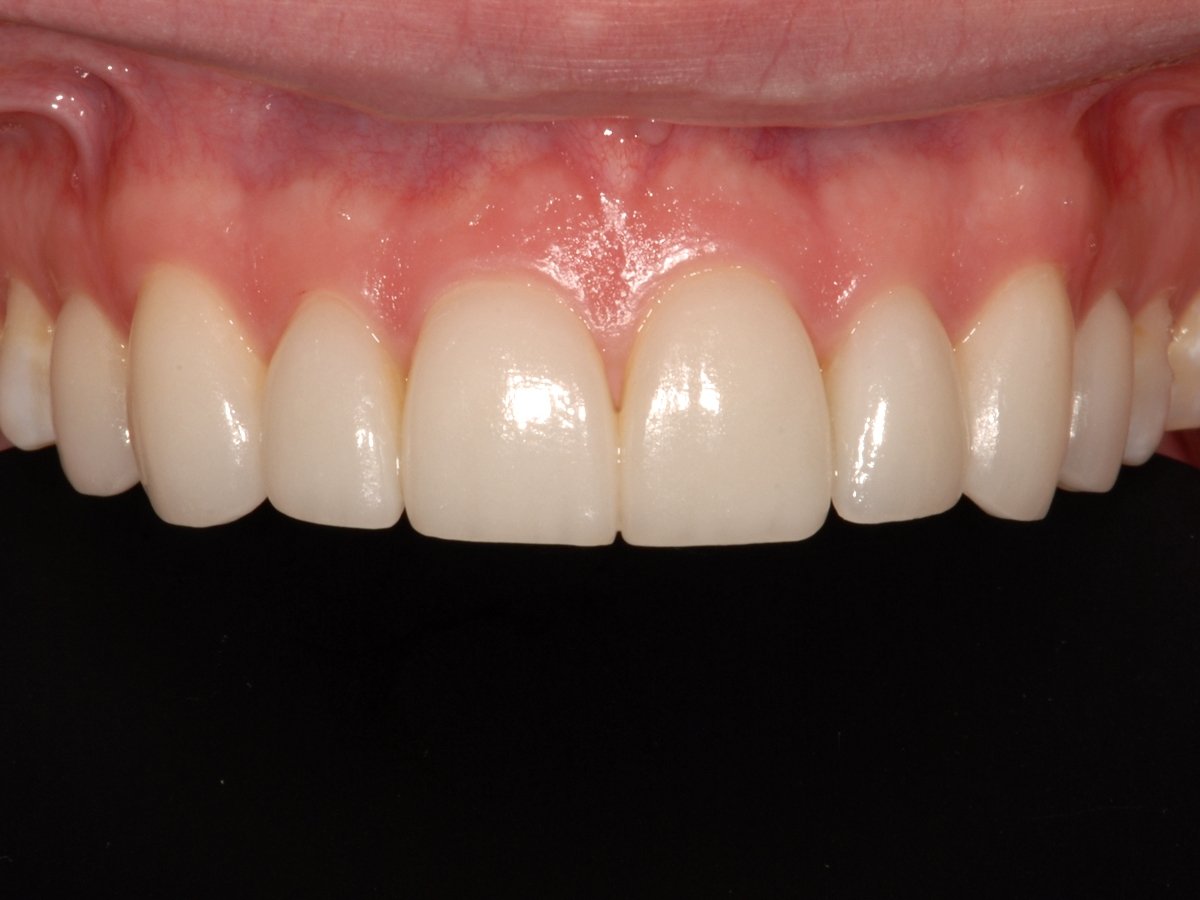 Thin Veneers After 