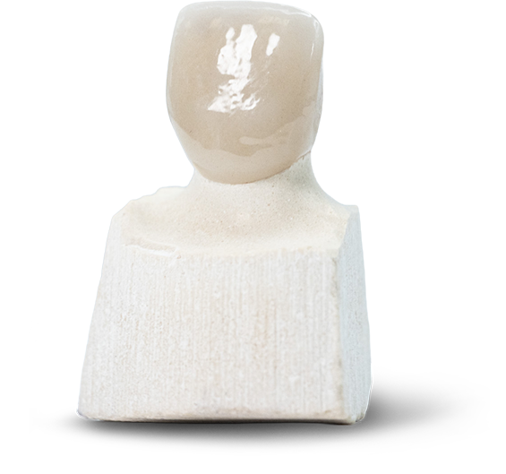 e.max Veneers Hero@0.5x