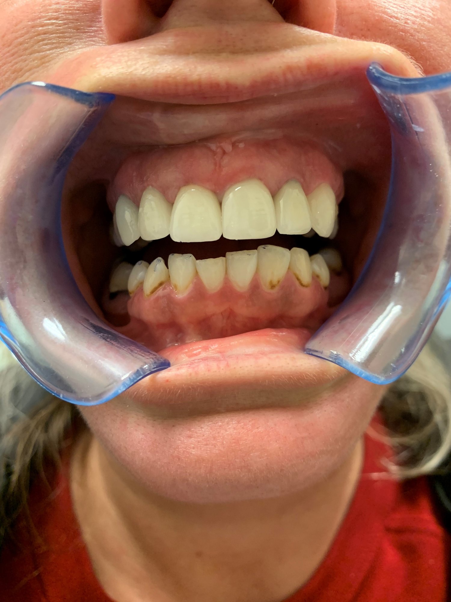 emax layered veneers