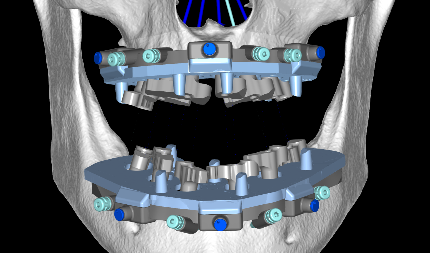 ArchBridge GuidedSMILE Digital Plan-1