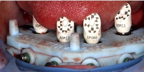 GuidedSMILE Digital ArchBridge Images (1)