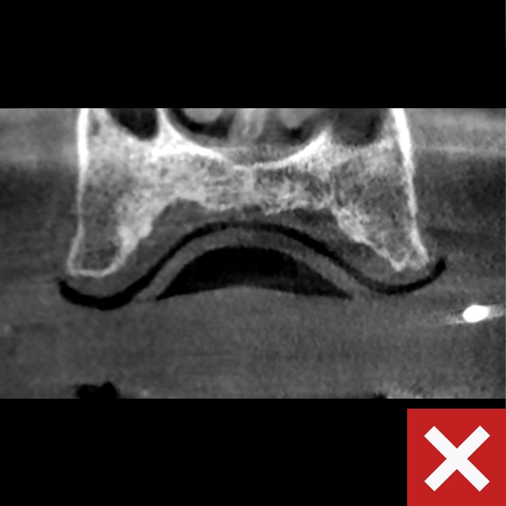 Labeled-CHROME-CBCT-Denture-Bad Labeled-CHROME-CBCT-Denture-Bad