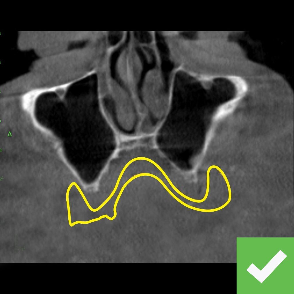 Labeled-CHROME-CBCT-Denture-Good Labeled-CHROME-CBCT-Denture-Good