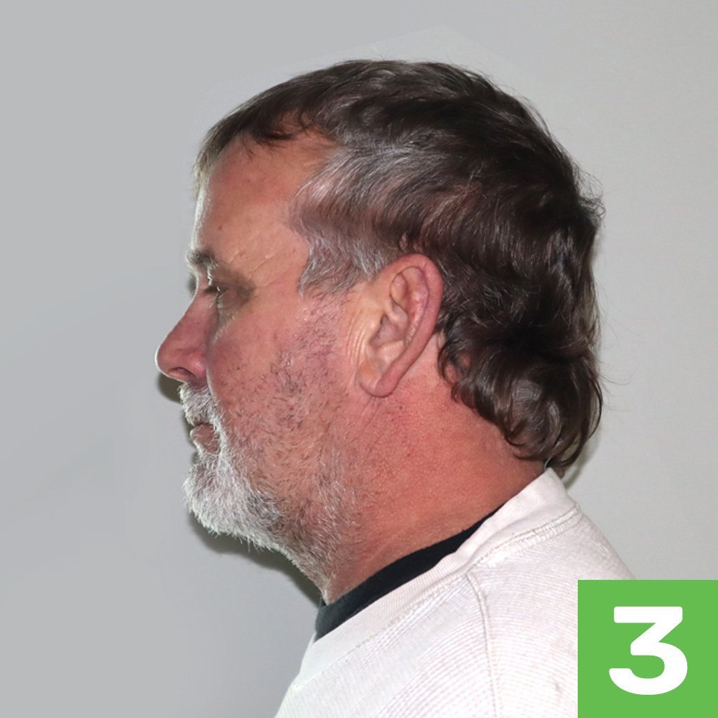 Labeled-CHROME-Patient-Photos-3 Labeled-CHROME-Patient-Photos-3