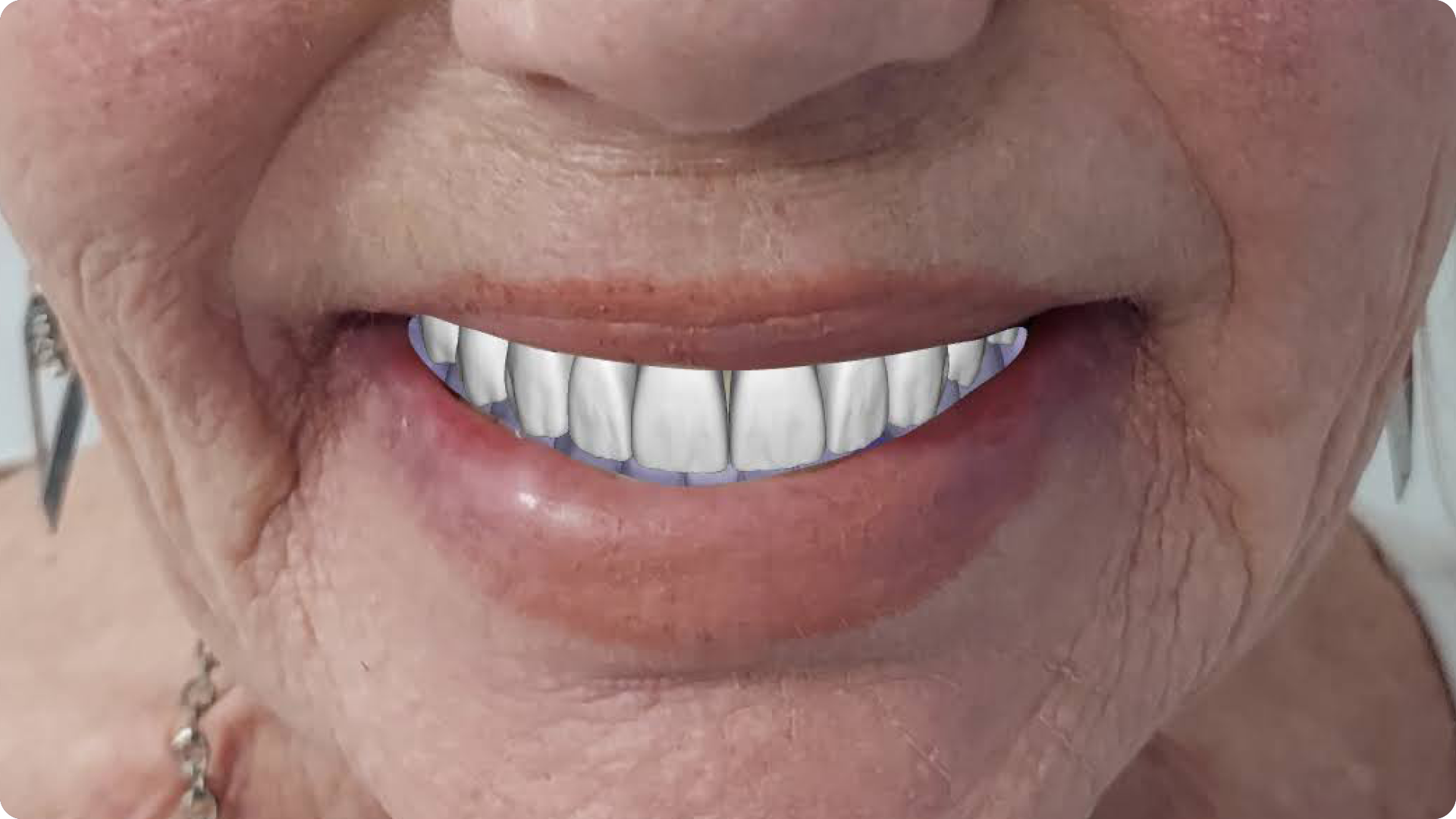 Cosmetic Smile Design_01