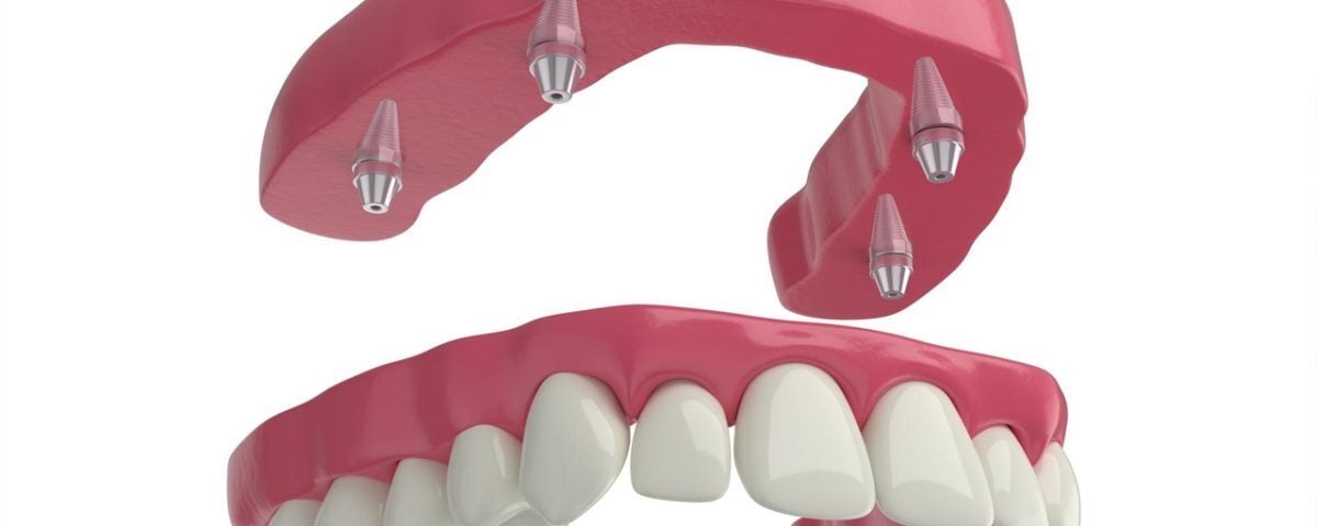 Full-Mouth-Dental-Implants-and-Full-Arch-Implants