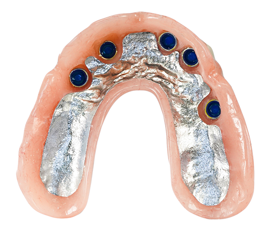 Locator Overdenture Overview@0.5x