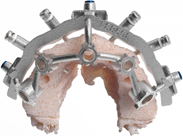 CHROME-Components-Stacked-Osteotomy-Guide-600x445