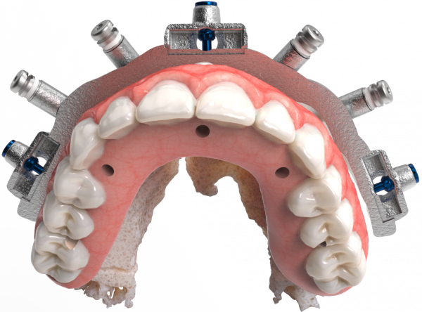 CHROME-Components-Small-Hole-Prosthesis-600x444