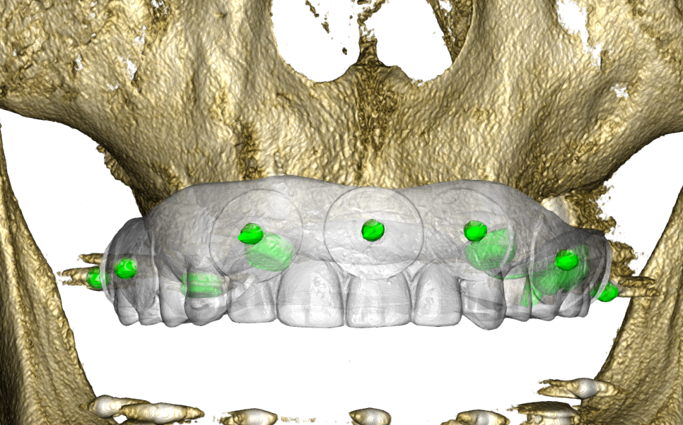 Removable Prosthesis Dual Scan