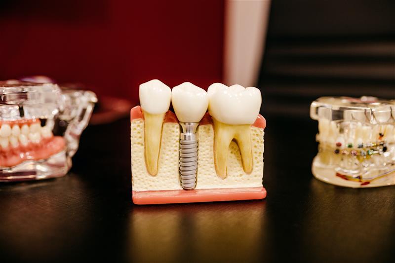 Stock Dental Implant Models